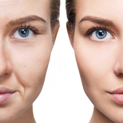 biomicroneedling-1
